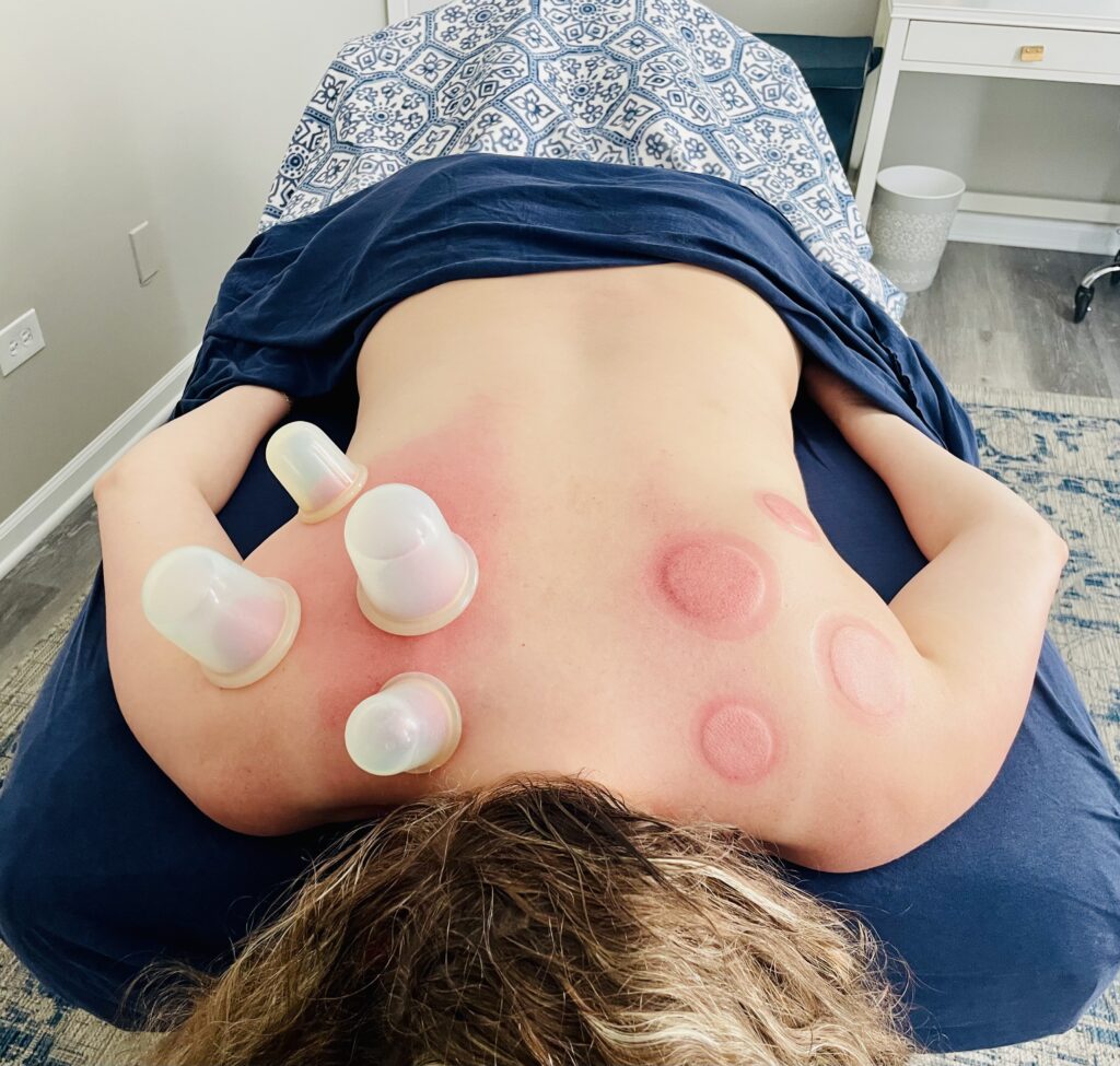Person receiving cupping therapy on their back.