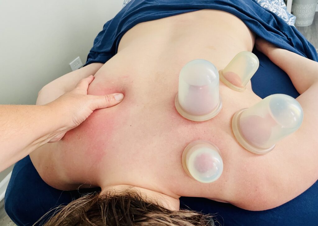 Cupping therapy on a person's back with suction cups applied.